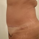 10 weeks post op