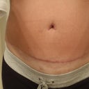10 weeks post op