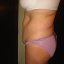I have very little fat on my arms, hips, thighs, or butt.  All in the tummy and flanks.