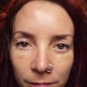 a symitary after sugery