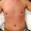 4 days post op