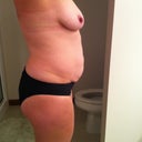 You can really see the ventral hernia on this view.