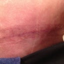 Wow look at my scar.  6 weeks and I can barely see it.  Amazing.