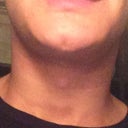 After.  Can be compare to the photo before the previous to this.  Chin Utterly sucked out. Shape, definition, protrusion, sharpness all gone.