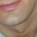 Before. Chin full volume. Protruding. Chin Side on (my) left side of face very gradually protrudes out (toward viewer). Chin long and upturned. Natural angles and "continuity".
