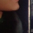 After. Only a couple years later. Volume sucked out from all directions. Very little left of chin. Weakened profile. Chin Sides/ Cheeks utterly "peeled away" from Lip-End. FLAT. FEATURELESS. NO LONGER UPTURNED. STARK GAP VERY VISIBLE.