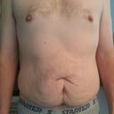 Before Photo Front - Scar below belly button was from a wreck when I was a teen and they checked for internal bleeding and got stitched up bad.