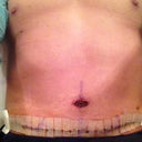 4 days post-op
