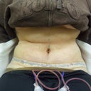 1 day Post op