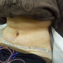 1 day post op other side.