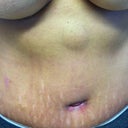 Not sure what that is? It has not changed at all. I am now 15 weeks post op.