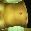 Swelling under my breasts never changes. It always looks like that.