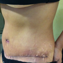 Very unhappy with my shape. I do not mind the scars. I should have just kept the old ones. Now I am more self conscience.