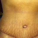 Above my belly button is starnge. I call it "The confused zone"
Under my breasts sticks out.  You can see it through my clothes. He did not do lipo, which I think would have given me a shape.