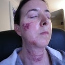 4 days after treatment with limelight
