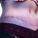 6 weeks po - close up of incision.. stretch marks make it a little bump hoping it settles a bit more but still very happy with the contour of my tummy now :)