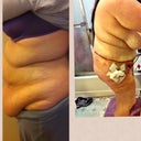 Day 5 and before from the side. Can't wait to see what I'll look like with a bra and regular clothes on!!