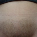 5 o'clock shadow, brown circles more noticable across top and brown lines on right side. The light parts are where the laser didn't touch. Hope shaow goes away.