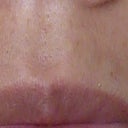 mustache after only 1 treatment. It is more noticable than the pics reveals.