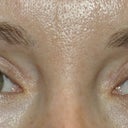 Check out how uneven my eyes are.  My eyelids used to be symmetrical.  Look how the upper eyelid doesn't curve and follow the shape of my eyes.