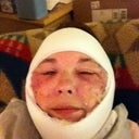 This is the next day and the only swelling I had and it was gone by day three.