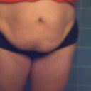 Night before surgery. Front view