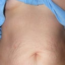Before surgery, front