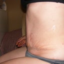 Three weeks after surgery, sitting