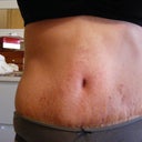 Three weeks after surgery, front