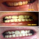 NEW PICTURE!  This is now.  Whiter, Brighter and more happy then ever.  Thanks again Zoom.  Your amazing!