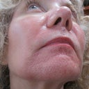 First day or two after first treatment