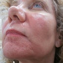The pores and wrinkling and scars on chin are what we are targeting mostly, along with pores on nose
