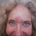 Aggressive treatment on forehead, redness persisted about two weeks, needed to cover with aquaphor all the time.