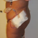 Side view a little blurry my incision goes back really far!