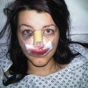 1 hour after surgary very painfull 