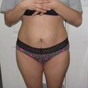 Day before surgery