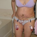 day 4 post op