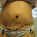 day 4 post op