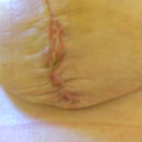 3 weeks PO - incision seems to be spreading and draining.