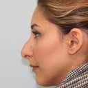 Before - Side Profile