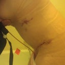 side view, you can see the scar and I am assuming the bruises are from the lipo?