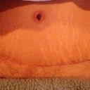 Week 5 scar 2 1/2 weeks w oleevA silicone strip