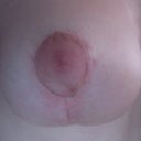 3 weeks post op, irritation from surgical tape