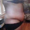 side view of seroma...