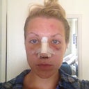 Day 3 - Front View. Hello puffy cheeks! Doesn't look so bad, but there is A LOT of dried blood and fresh blood in my nostrils.