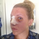 The "bad" eye. This picture doesn't really do my eye bruising justice, but it's quite a shiner.
