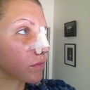 The "good" eye. Swollen, but not as bruised.