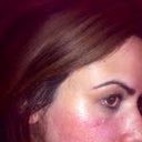 One week in... my skin looks terrribly red still and very bumpy... but overall scars are about 60 % improved as of now :-)