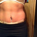 6 weeks post op still swollen right side might need insicion correction not tight