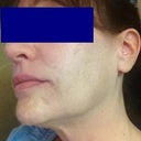 043013 - with moisturizer and makeup. The recent IPL really brought out my freckles.
